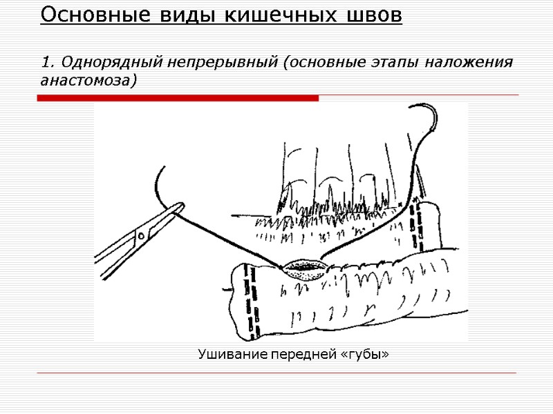 Основные виды кишечных швов  1. Однорядный непрерывный (основные этапы наложения анастомоза) Ушивание передней